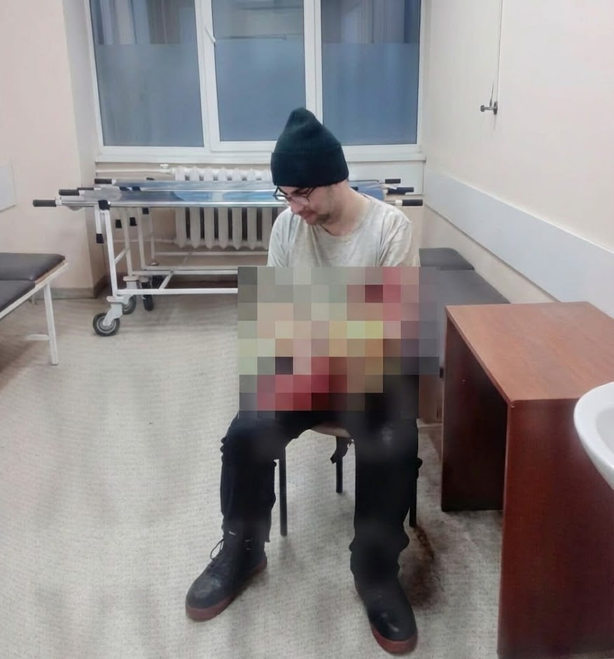 В Одессе мужчина попытался отпилить себе руку, чтобы не попасть под мобилизацию