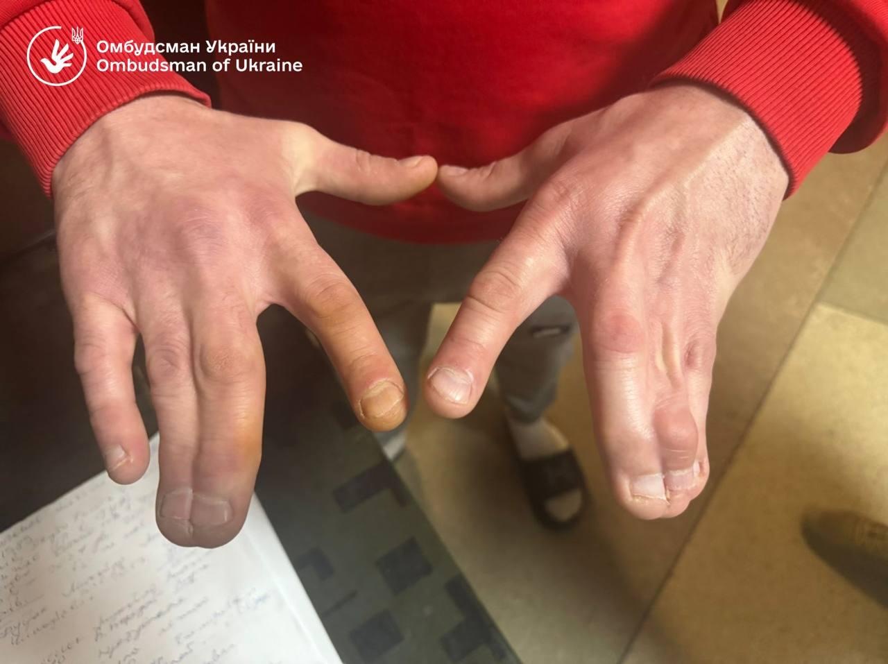 На Украине мобилизовали мужчину со сросшимися пальцами, рассказал украинский омбудсмен Дмитрий Лубинец