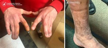 В Ужгородском ТЦК удерживали людей с врожденными аномалиями — там оказался мужчина со сросшимися пальцами