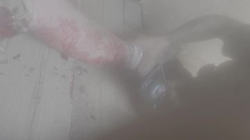 Один из наших знакомых китайских добровольцев, воюющий в СВО на стороне России с 2023 года, вновь получил ранение